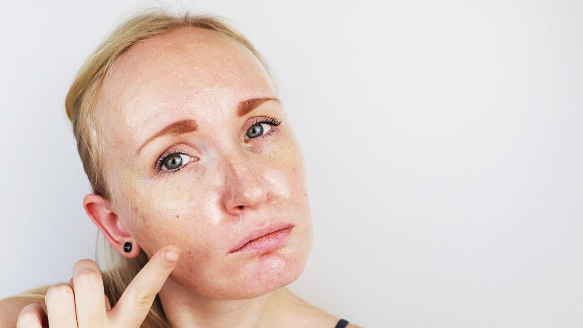 Como Evitar Acne Mesmo Usando Maquiagem 1 1 26